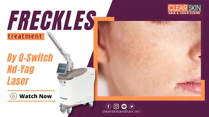 Q SWITCH ND YAG LASER Treatment for Freckles || Best Laser Treatment for Freckles || Dr.N.Kailash
