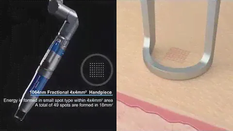 Qfit - Premium Q-switched Nd YAG Laser by Hironic