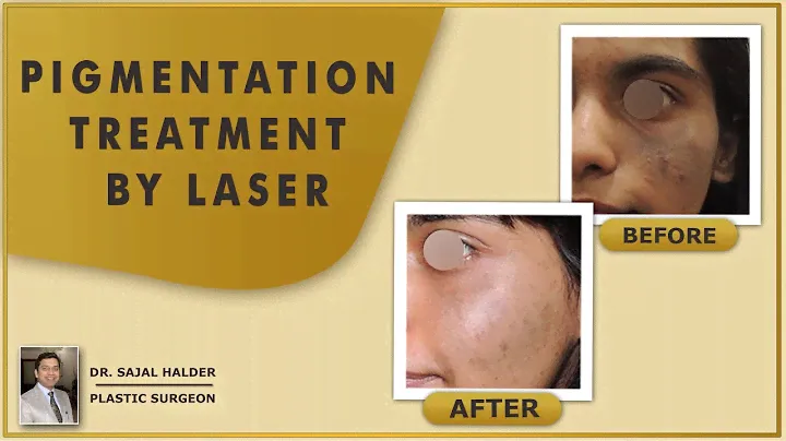 Pigmentation treatment by Q Switch Nd YAG Laser